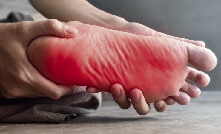 A person holding their foot which is bright red indicates the pain that can be felt in the feet from Neuropathy. Maumee Integrated Health can help resolve nerve pain with our Neuropathy Treatment.